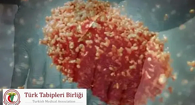 Maymun Çiçeği (Mpox) Hastalığında Ölüm Oranları Nedir ve Riskler Nasıl Yönetilir? Türk Tabipleri Birliği’nin Güncel Açıklamaları Ne?