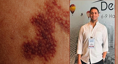 Kırklareli Eğitim ve Araştırma Hastanesi'nden Uyarı: Cilt Değişikliklerini Hafife Almayın