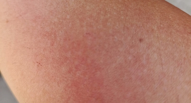 Kırklareli'de Sıcak Hava Sinekleri Arttırdı: Isırıklara Dikkat!