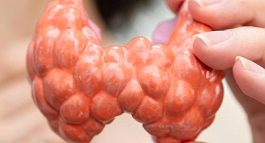 Lenfoma Belirtilerine Dikkat: Erken Teşhis Hayat Kurtarıyor